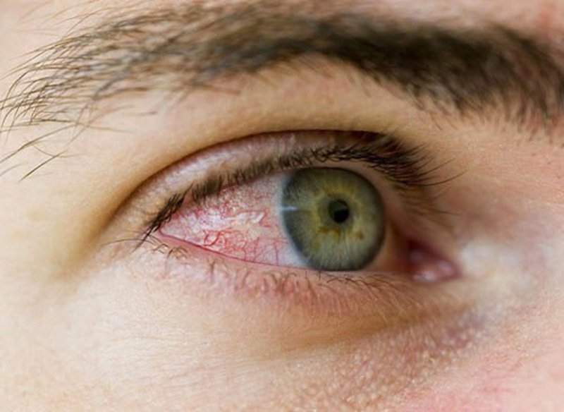 Bệnh viêm kết mạc mắt: Nguyên nhân, triệu chứng, cách điều trị và phòng  tránh | Vinmec