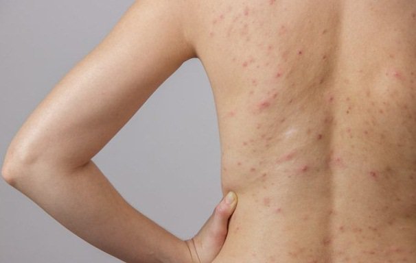 Điều trị viêm nang lông thế nào? | Vinmec
