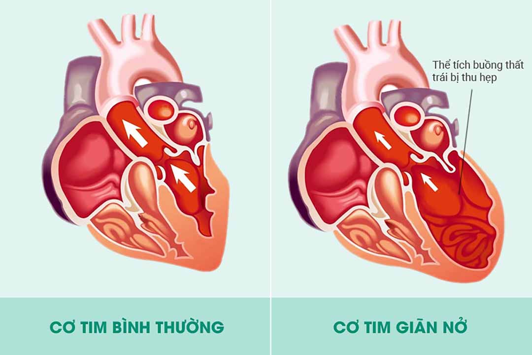 Bệnh tim và bệnh cơ tim giãn