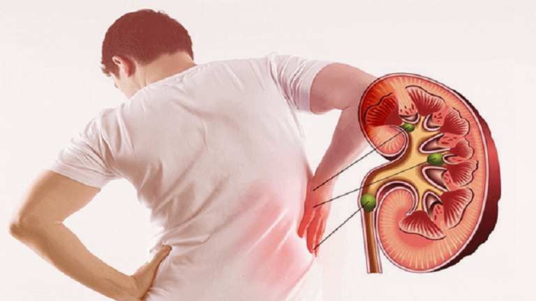 Viêm Thận Bể Thận Cấp Tính: Nhận Biết Sớm Để Điều Trị Kịp Thời
