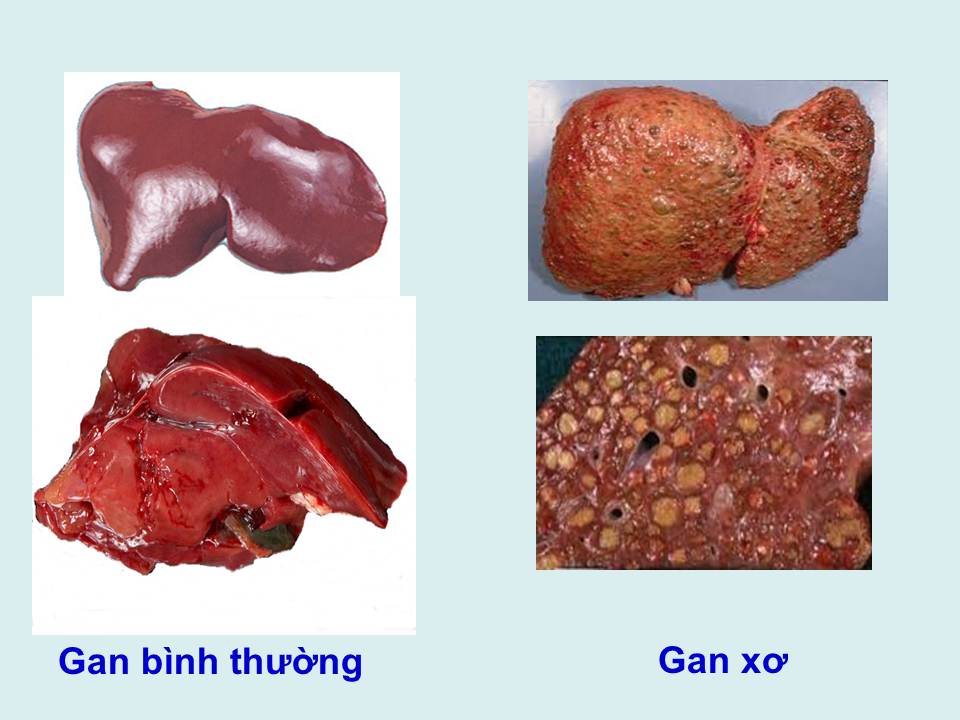 Điều trị bệnh xơ gan - Yte123.com