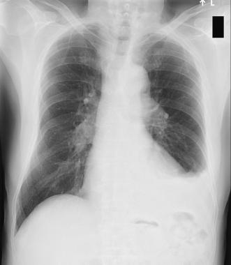 Nguyên nhân và điều trị tràn dịch màng phổi thanh tơ - Yte123.com
