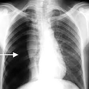 Triệu chứng và điều trị tràn khí màng phổi tự phát - Yte123.com