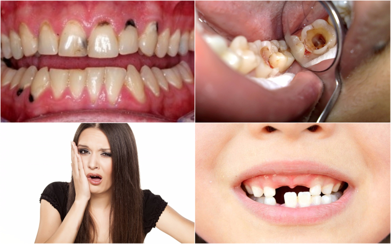 Triệu chứng bệnh sâu răng