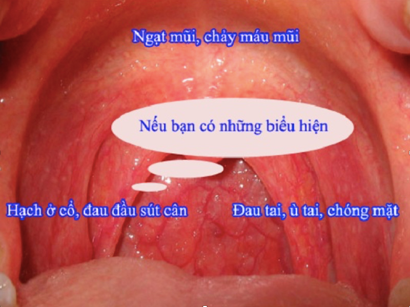 Triệu chứng ung thư vòm mũi họng