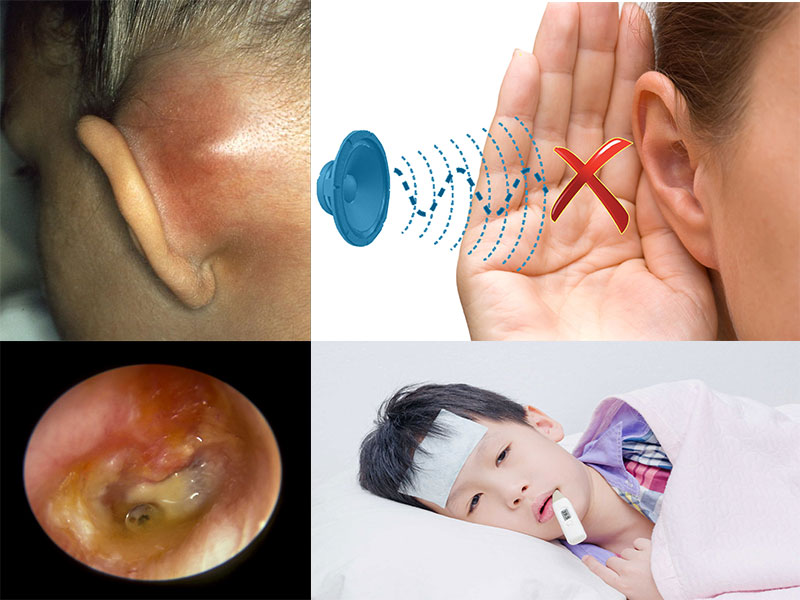 Triệu chứng, dấu hiệu của viêm tai giữa