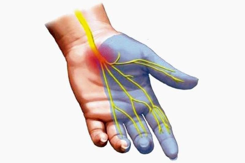 Hội chứng ống cổ tay gây ra chèn ép dây thần kinh giữa