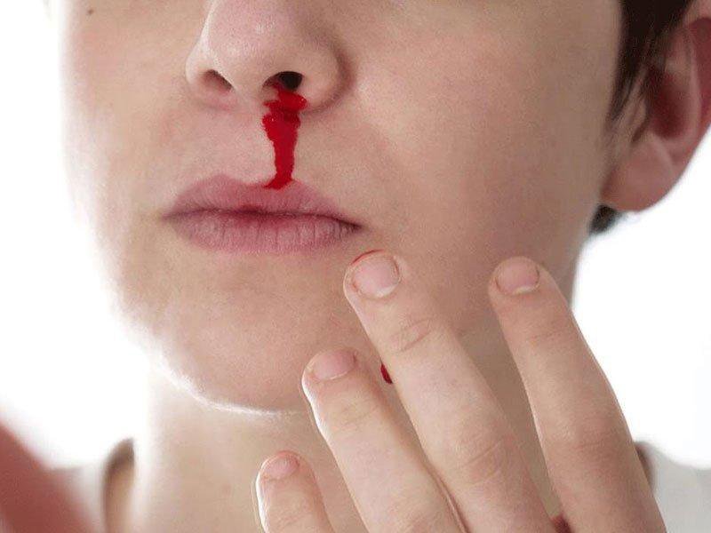 Cảnh giác biến chứng chảy máu mũi khi sốt xuất huyết