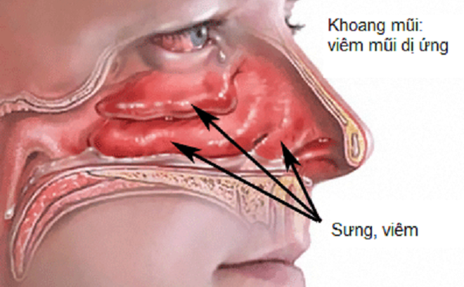 Các bệnh thường gặp ở tai mũi họng