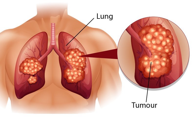 Dấu hiệu điển hình của bệnh ung thư phổi