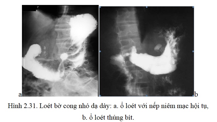 [Bộ Y tế] Chẩn đoán hình ảnh Xquang dạ dày và tá tràng