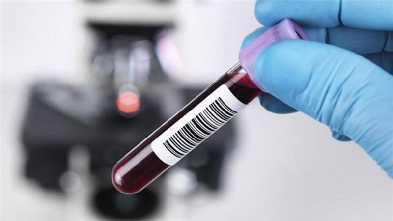 Xét nghiệm viêm gan B để kiểm tra có dương tính với virus gây bệnh hay không