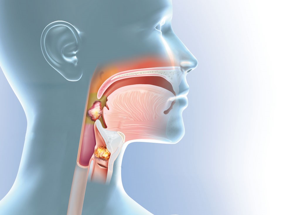 Ung thư vòm mũi họng - Vì sao hay phát hiện muộn?