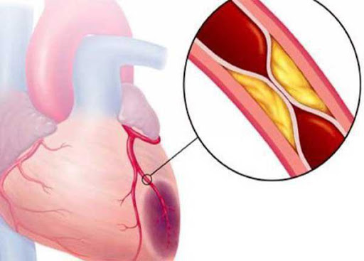 7 bệnh tim mạch thường gặp và các triệu chứng Thanh Vũ Medic Bạc Liêu