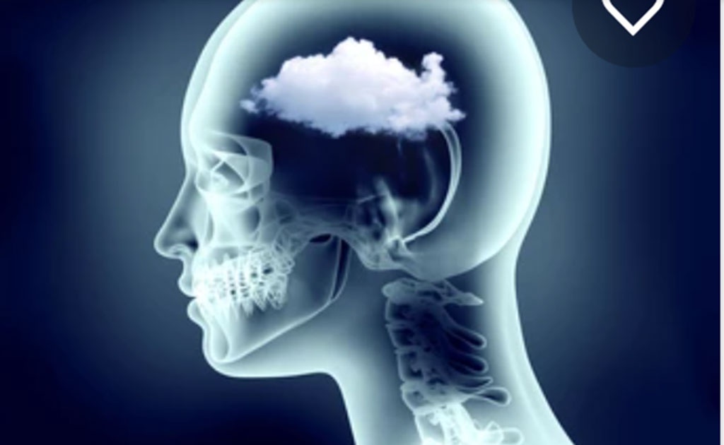 Bệnh nhân COVID-19 có nguy cơ cao bị tình trạng “sương mù não” kéo dài - Ảnh 2.
